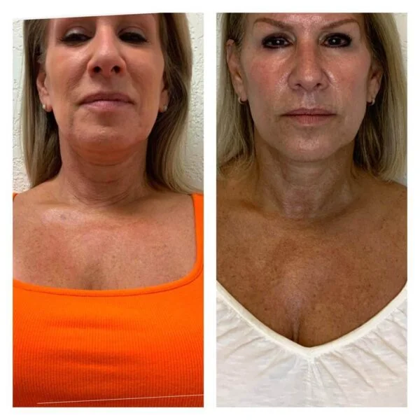 Double chin Treatments - Kybella - Image 2