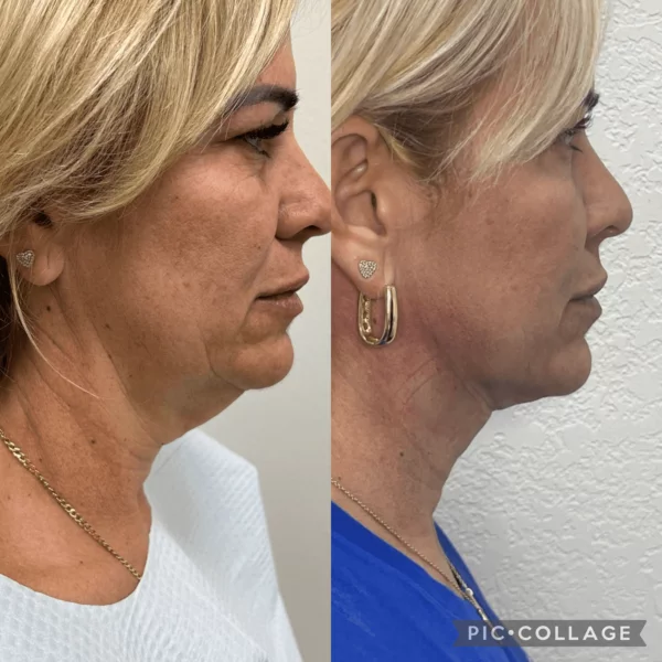 Double chin Treatments - Kybella - Image 3