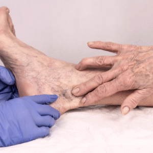 Spider Vein Treatment - Sclerotherapy