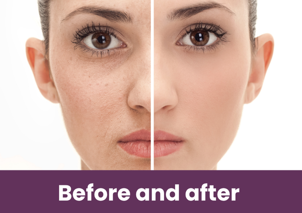 Before and After Sunspot Treatment